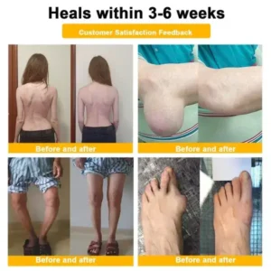 Botulinum Toxin & Bee Venom Pain-Relief Bone Healing Cream