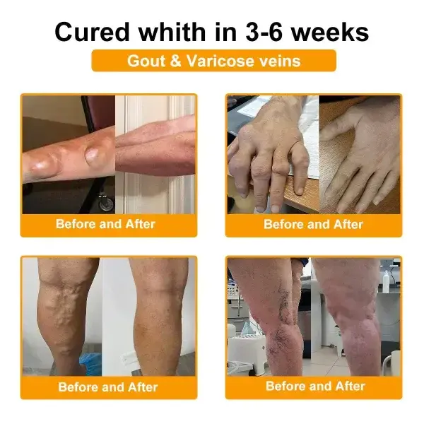 Botulinum Toxin & Bee Venom Pain-Relief Bone Healing Cream