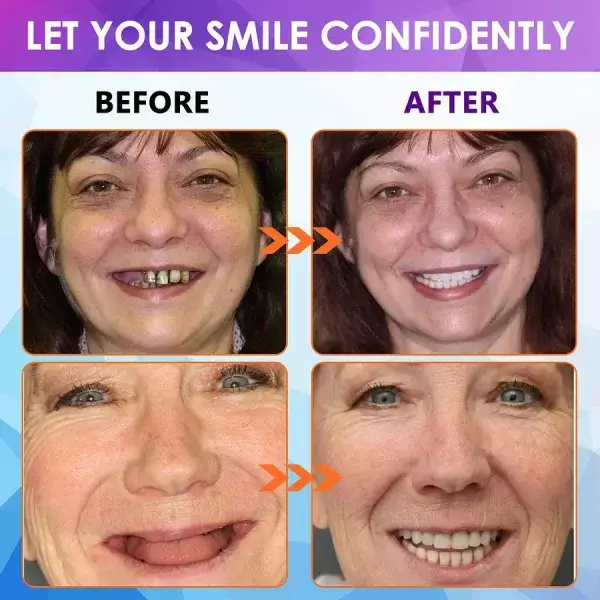 Advanced Customized Full Denture Set