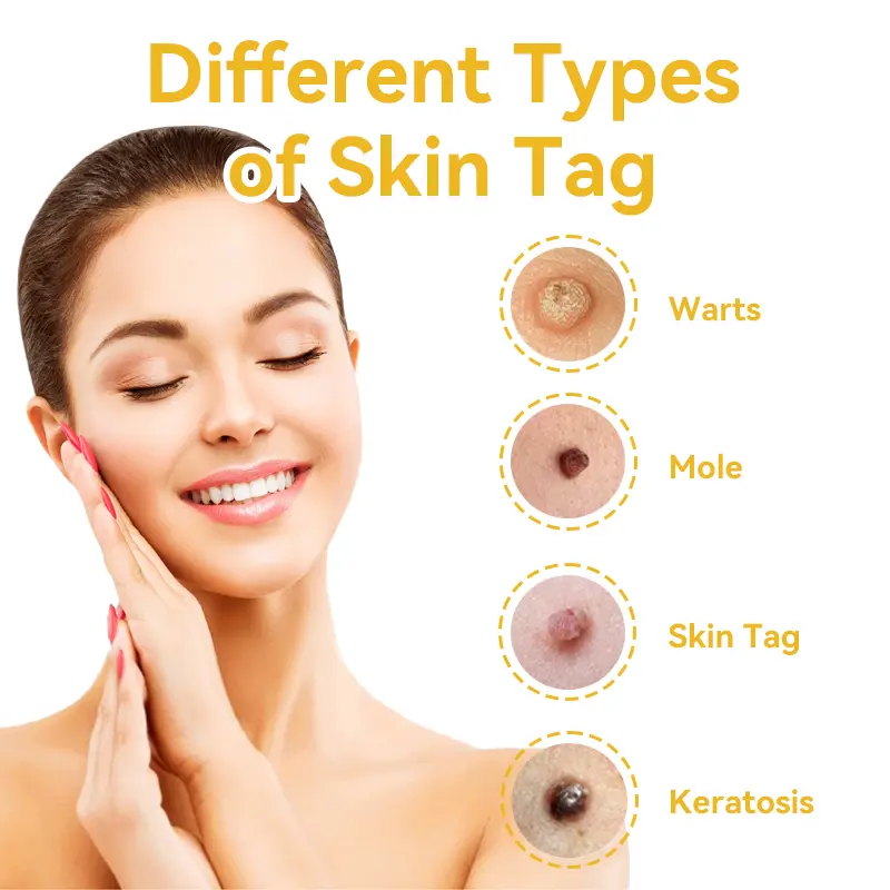 Bee Venom Wart & Moles Removal Cream - Image 11