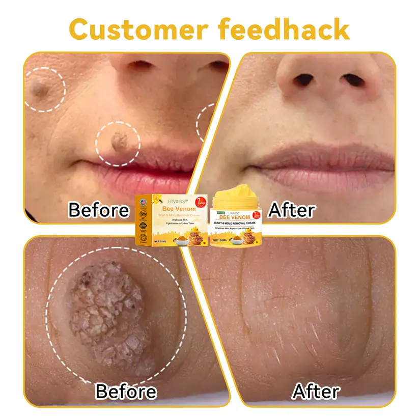 Bee Venom Wart & Moles Removal Cream - Image 5