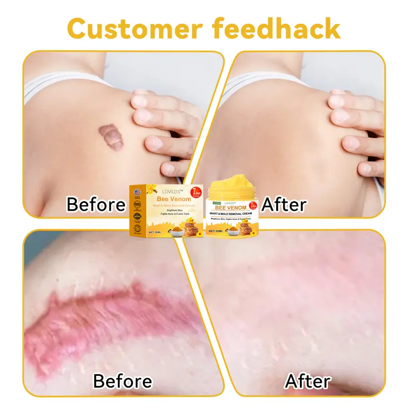 Bee Venom Wart & Moles Removal Cream - Image 9