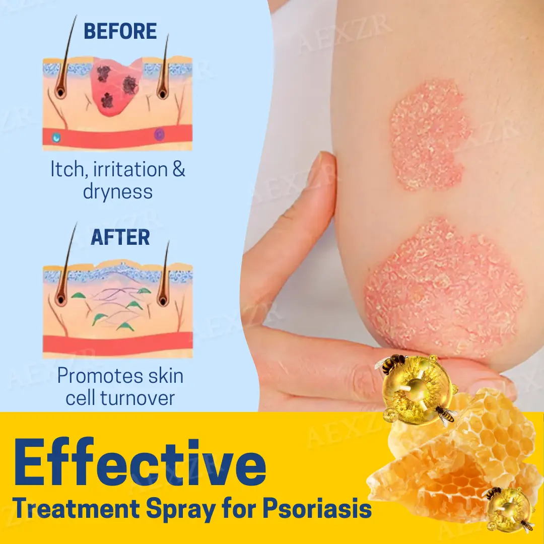 Bee Venom Psoriasis Treatment Spray - Image 3
