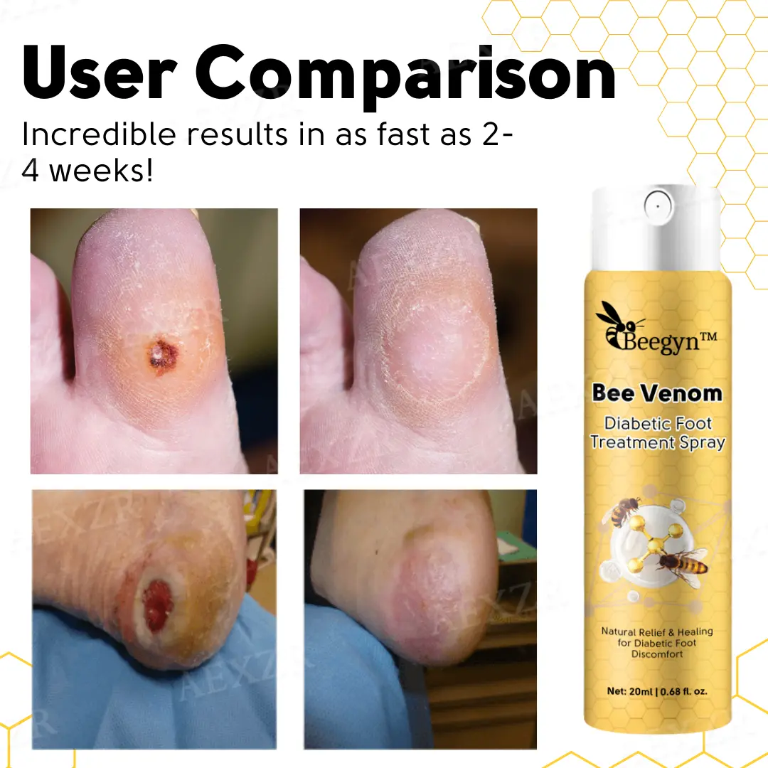 Bee Venom Diabetic Foot Treatment Spray - Image 2