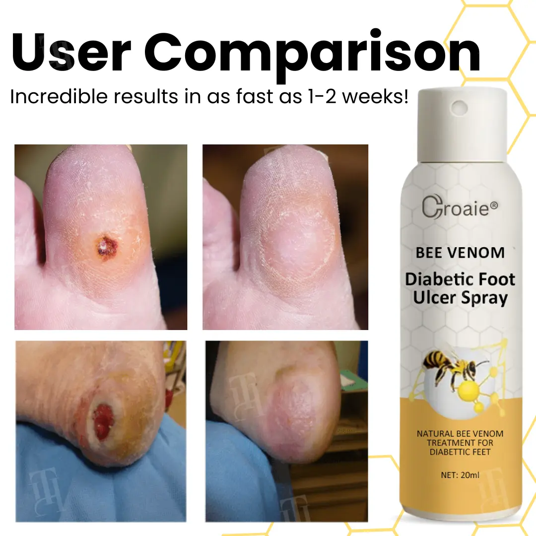 Bee Venom Diabetic Foot Ulcer Spray - Image 2