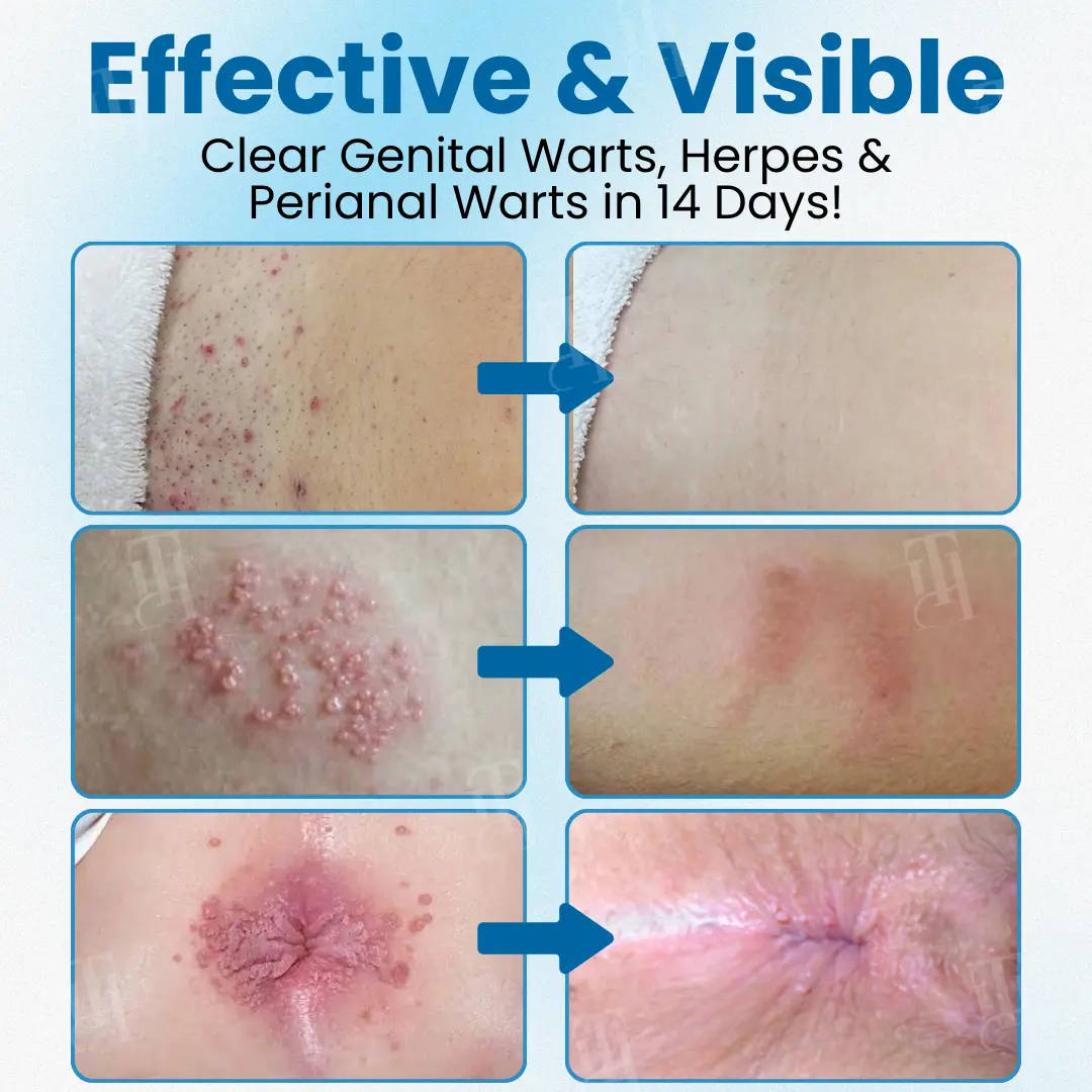 Nanolipo Genital Warts Relief Cream - Image 2