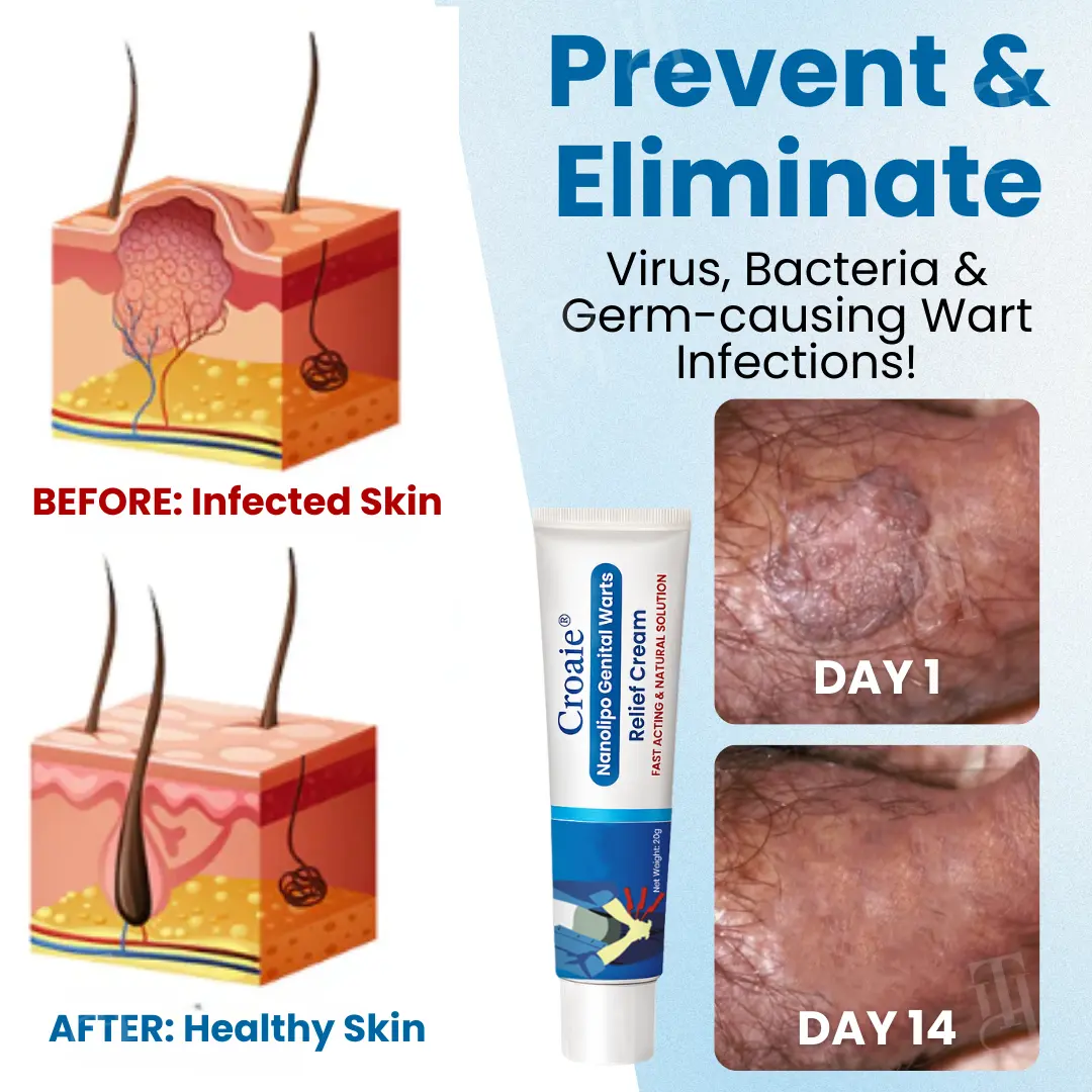 Nanolipo Genital Warts Relief Cream - Image 5