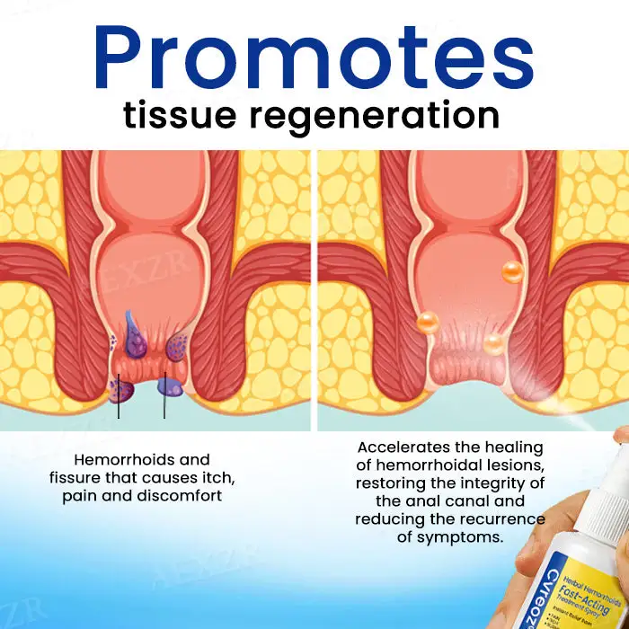 Herbal Hemorrhoids Fast-Acting Treatment Spray - Image 4