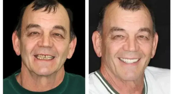 Full Denture Set Advanced Self-Adjusting Dental Materials - Image 14