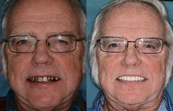 Full Denture Set Advanced Self-Adjusting Dental Materials - Image 8