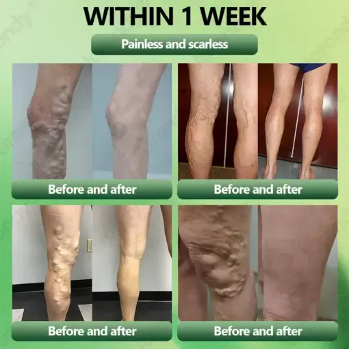 Horse Chestnut Vein Cream - Image 2