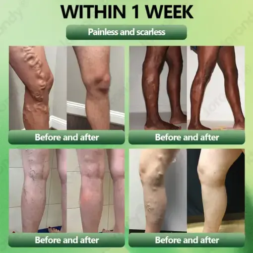 Horse Chestnut Vein Cream - Image 4