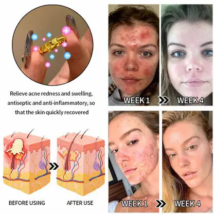 DIYSTAR Lymphatic magnetic therapy cats eye ring - Image 7