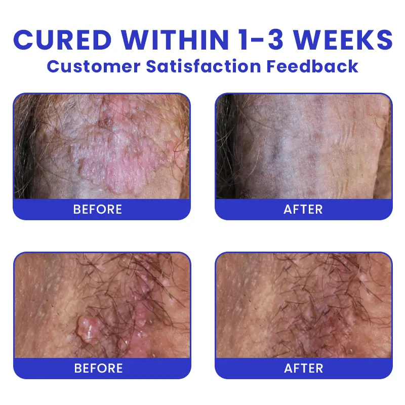 Genital Warts Remover Cream - Image 7
