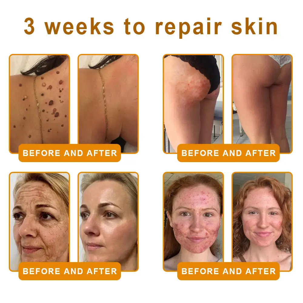 𝘽𝙀𝙀 𝙑𝙀𝙉𝙊𝙈 𝑺𝒌𝒊𝒏 𝑹𝒆𝒔𝒕𝒐𝒓𝒂𝒕𝒊𝒐𝒏 𝑪𝒓𝒆𝒂𝒎 - Image 8