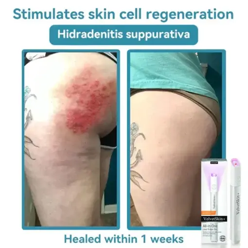 VelvetSkin+ All-in-One Laser Eraser Pen - Image 13