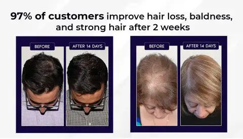 LOVILDS Natural Hair Regrowth Spray - Image 6