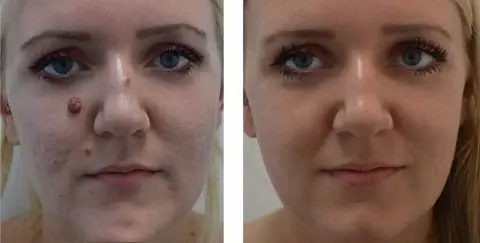 Bee Venom Mole and Wart Treatment Cream - Image 10