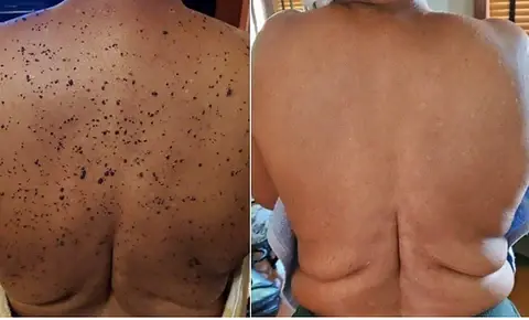 Bee Venom Mole and Wart Treatment Cream - Image 7