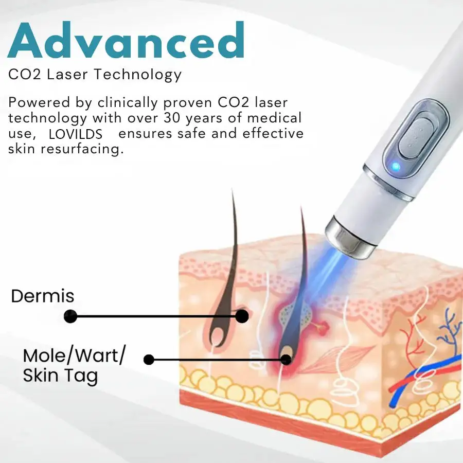 Non-Invasive Mole and Wart Removal Laser Pen - Image 7