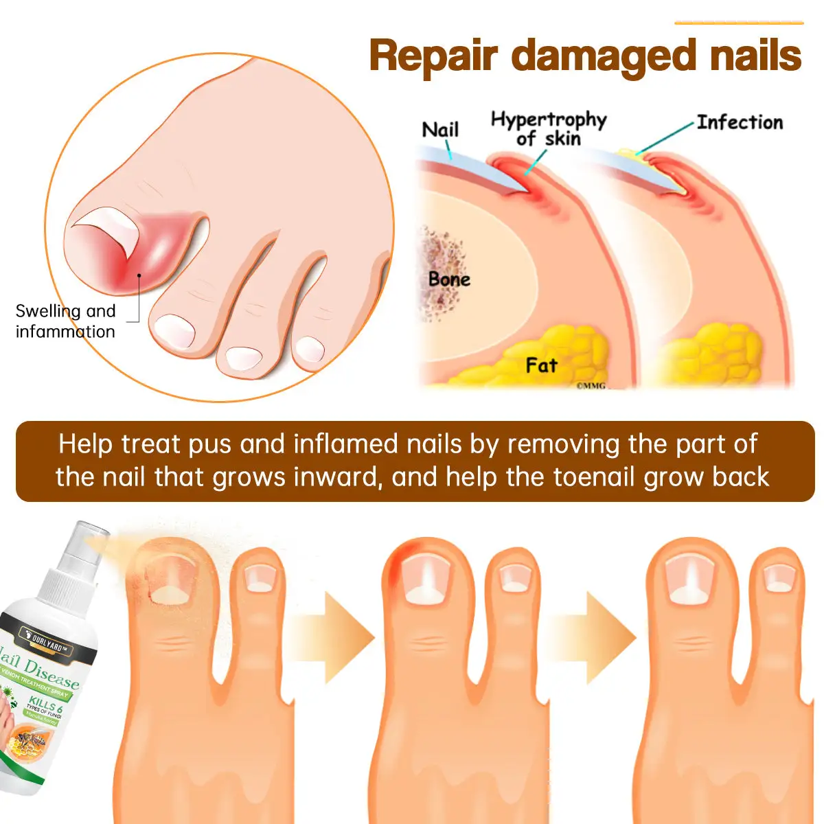 Bee Venom Nail Disease Treatment Spray - Image 3