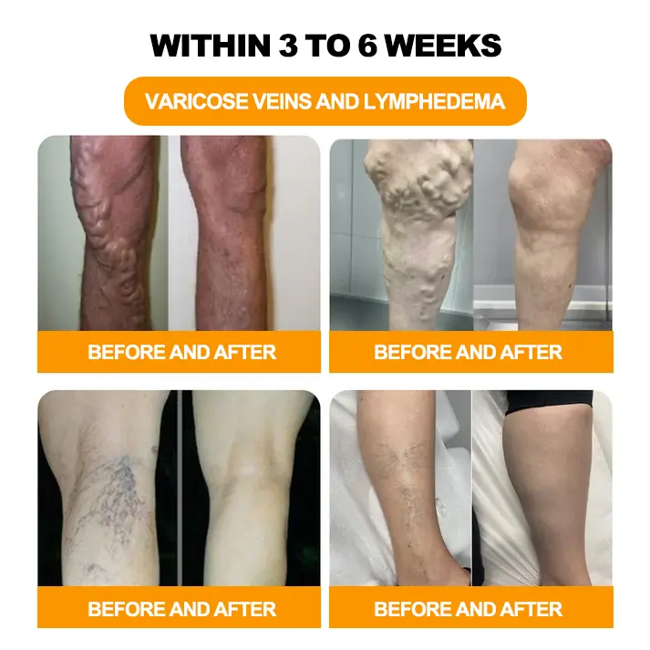 Bee Venom Lymphatic Drainage & Slimming Foot SoakBeads - Image 6