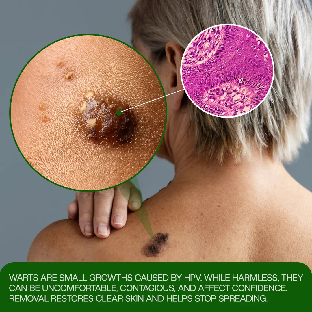 ClinixClear Wart Remover Patch - Image 5