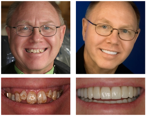 3D Dentures - Image 3