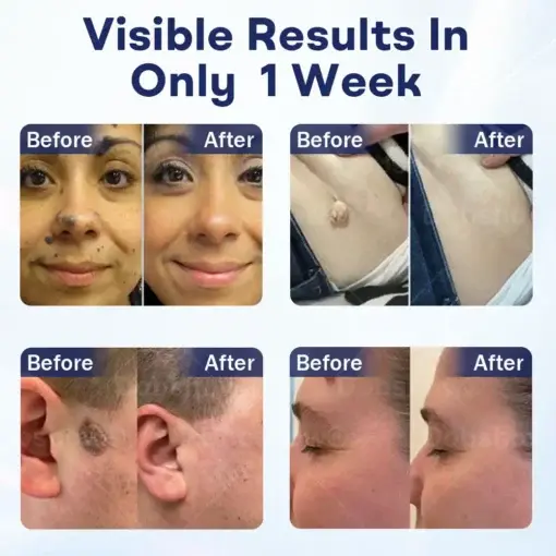 Mole and Wart Removal Cream - Image 2
