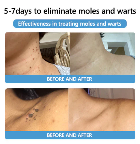 PRO Bee Venom Mole and Wart Treatment Cream - Image 5