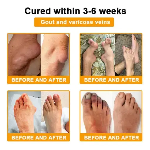 BEE VENOM LITHOSPERMUM Pain-Relief Bone Healing Cream - Image 5