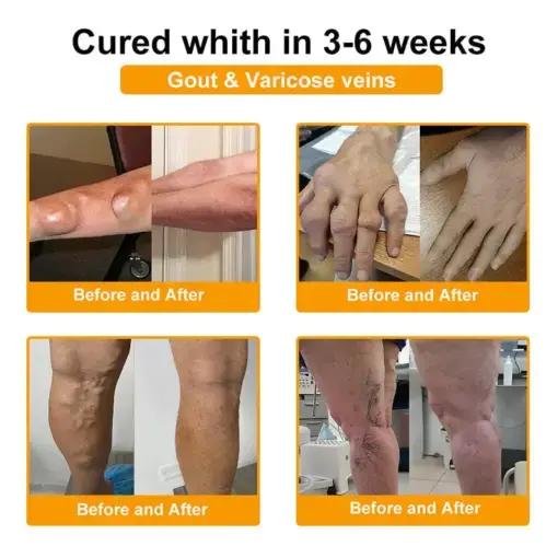 BEE VENOM LITHOSPERMUM Pain-Relief Bone Healing Cream - Image 7