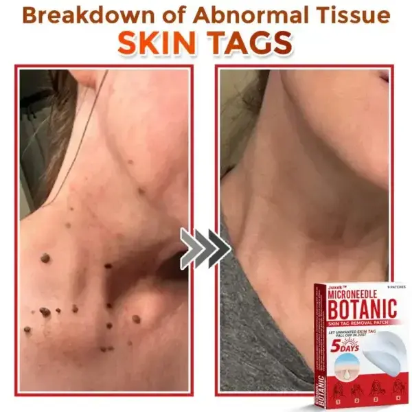 Removal Patch: Gentle Microneedle Patches for Skin Tag & Mole Removal - Image 2