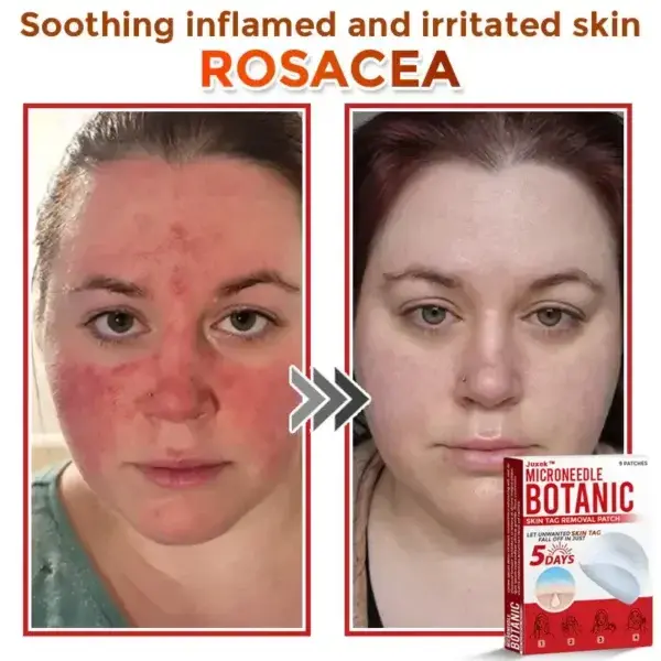 Removal Patch: Gentle Microneedle Patches for Skin Tag & Mole Removal - Image 5