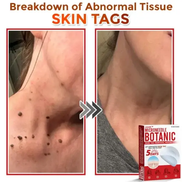 Removal Patch: Gentle Microneedle Patches for Skin Tag & Mole Removal - Image 2