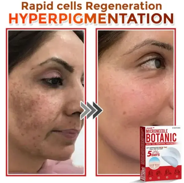 Removal Patch: Gentle Microneedle Patches for Skin Tag & Mole Removal - Image 6