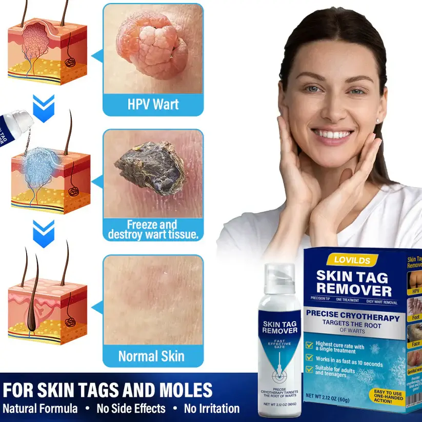 Cryo Treatment Spray Effortlessly remove skin tags and warts-no pain - Image 2