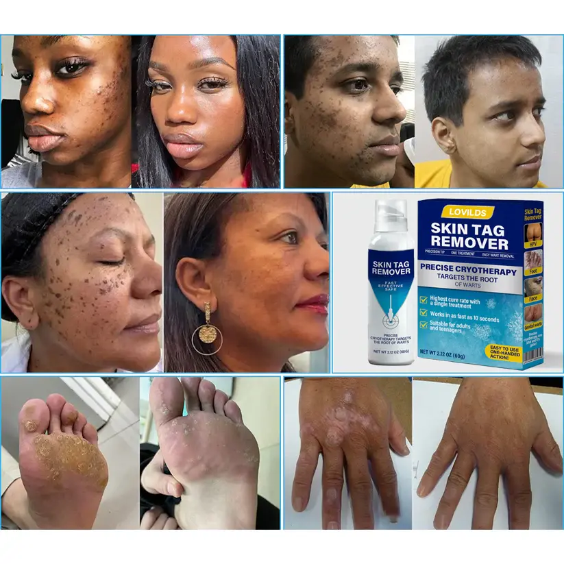 Cryo Treatment Spray Effortlessly remove skin tags and warts-no pain - Image 5