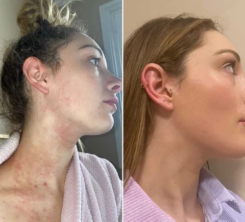 Bee Venom Eczema Treatment Cream - Image 8