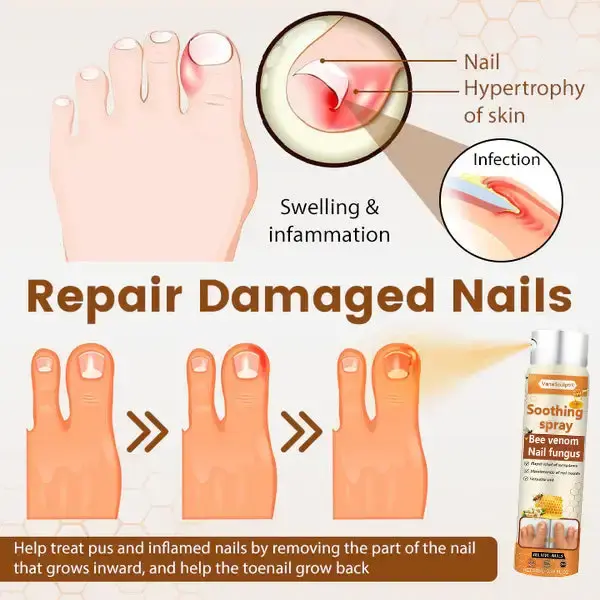 Bee Venom Nail Fungus Spray - Image 4