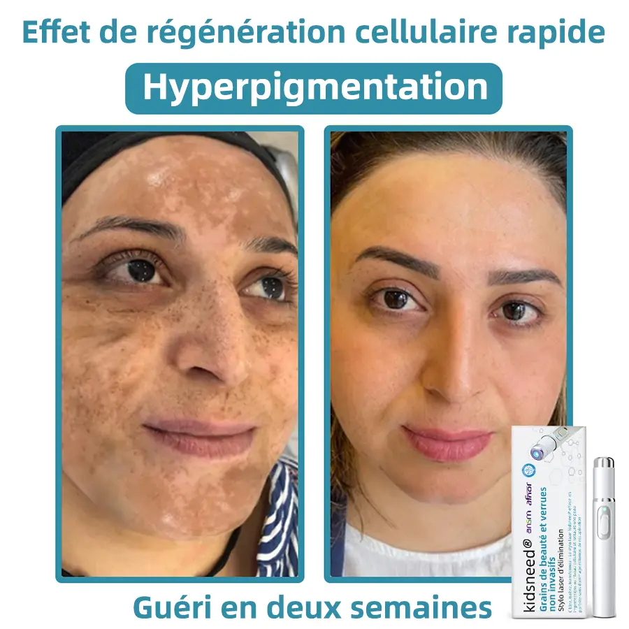 Grains de beauté et verrues non invasifs Stylo laser d'élimination - Image 11