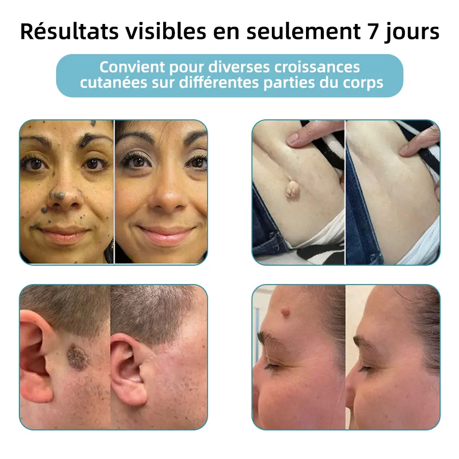 Grains de beauté et verrues non invasifs Stylo laser d'élimination - Image 3