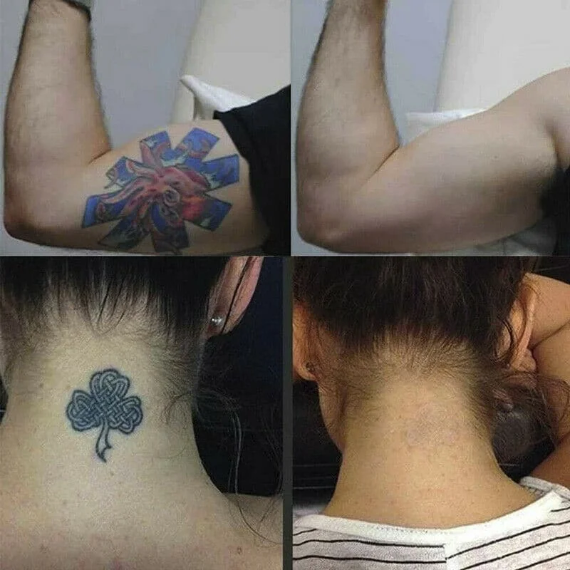 Permanent Tattoo Removal Cream - Image 2