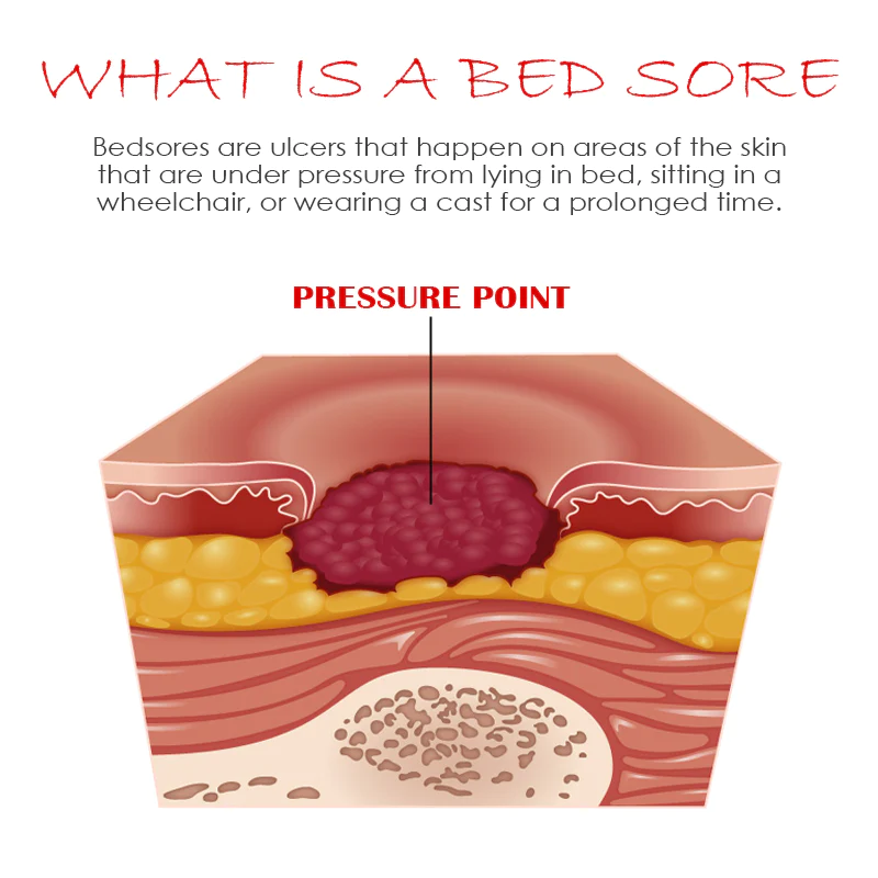 ATTDX BedSores FastHealing TreatmentCream - Image 6