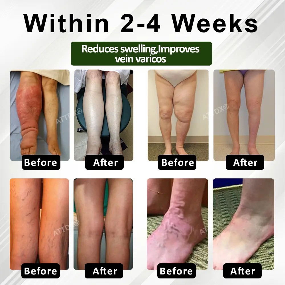 FluidEase Leg Therapy Edema Cream - Image 3