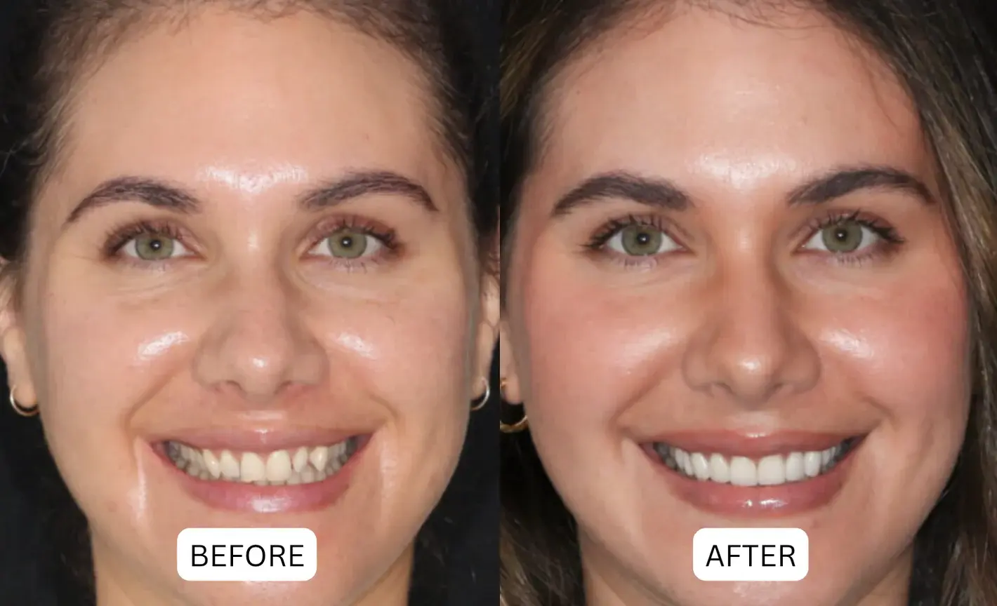 Teeth Armor Drops - Image 4