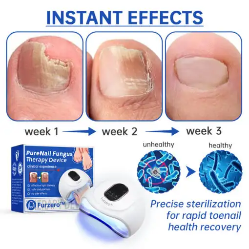 Advanced PureNail Fungus Laser Device - Image 5