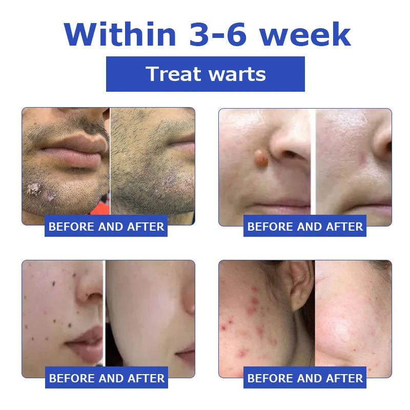 OceanCure Bee Venom Psoriasis & Wart Healing Cream - Image 10