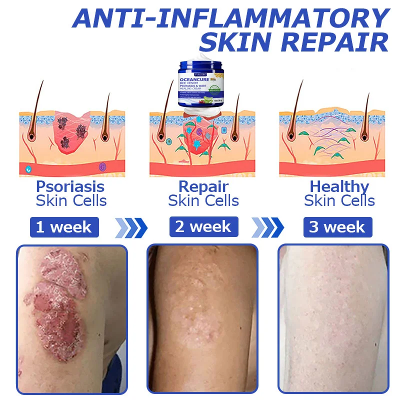 OceanCure Bee Venom Psoriasis & Wart Healing Cream - Image 12