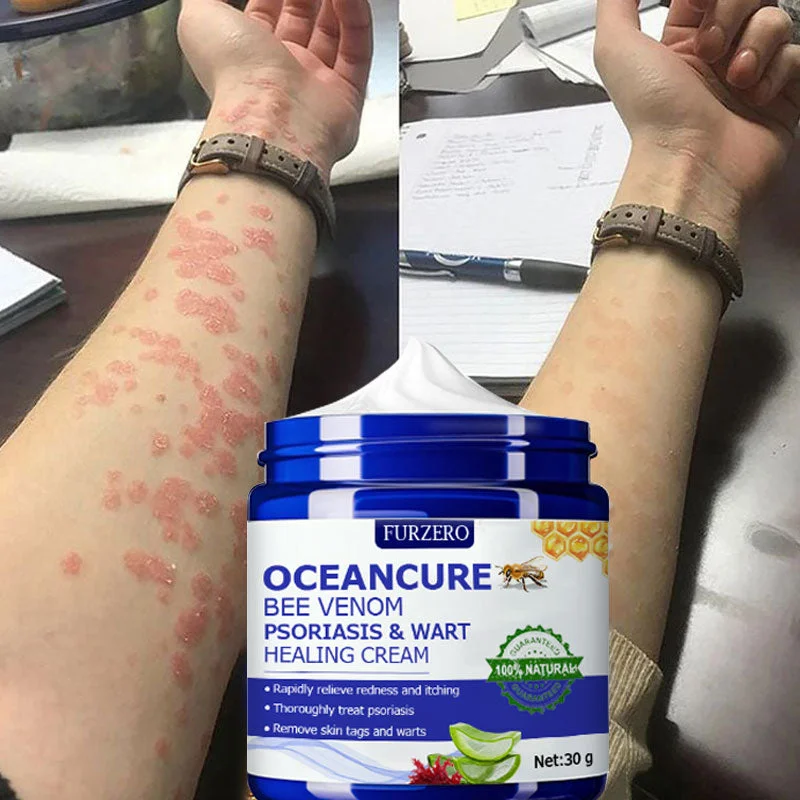 OceanCure Bee Venom Psoriasis & Wart Healing Cream - Image 5